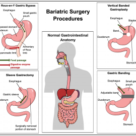 Bariatric Surgery Complications (NLevy/ACherney)