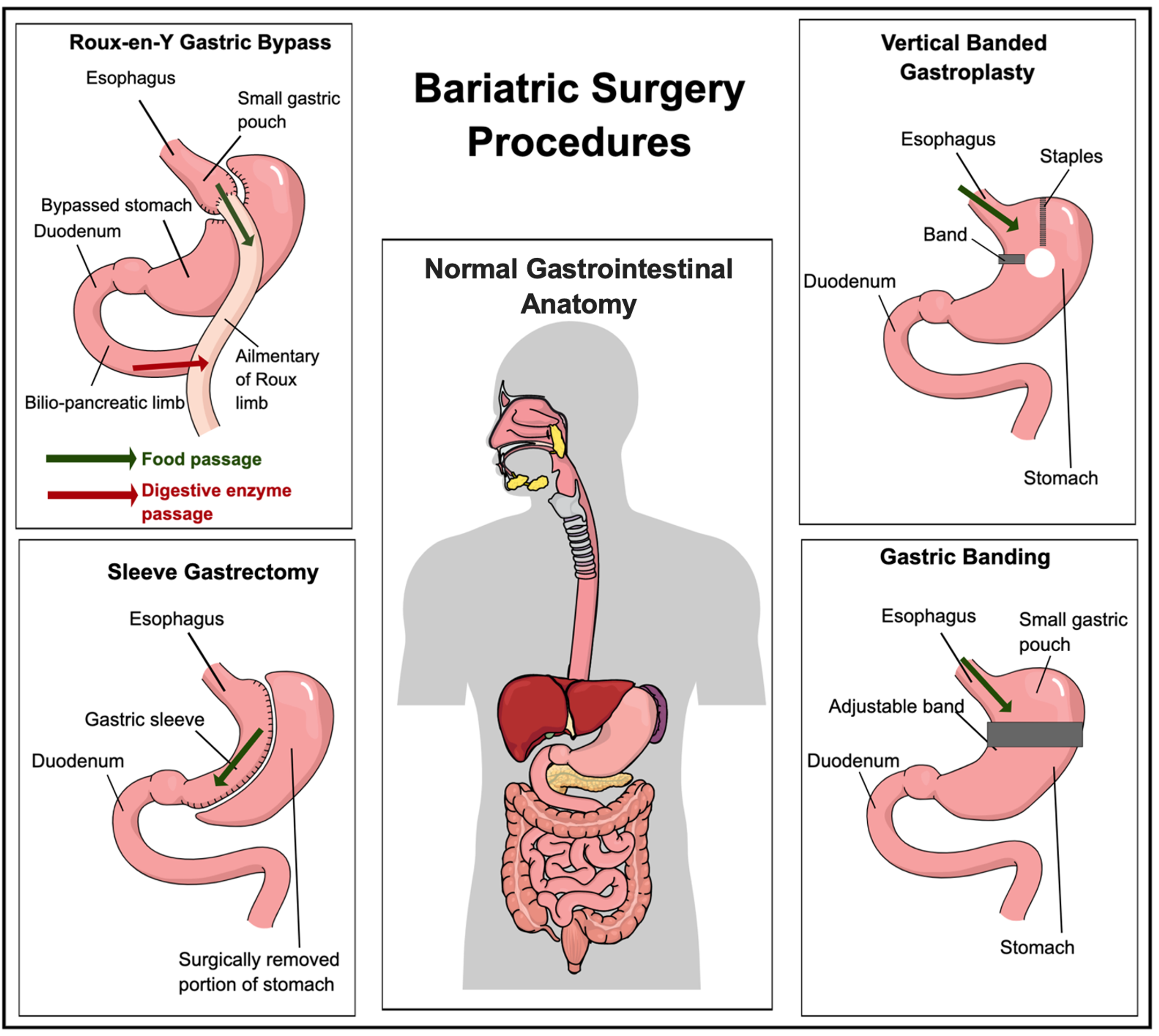 Read more about the article Bariatric Surgery Complications (NLevy/ACherney)