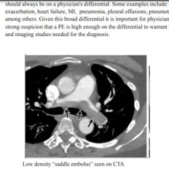 Read more about the article Pulmonary Embolus (NRapp/CLaoteppitaks)