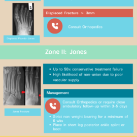 5th Metatarsal Fractures (Fischer, Pasirstein)